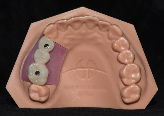 comprare Implantazione di porcellana fusa con zirconia Implantazione di croce ponte altamente estetico online manufacture