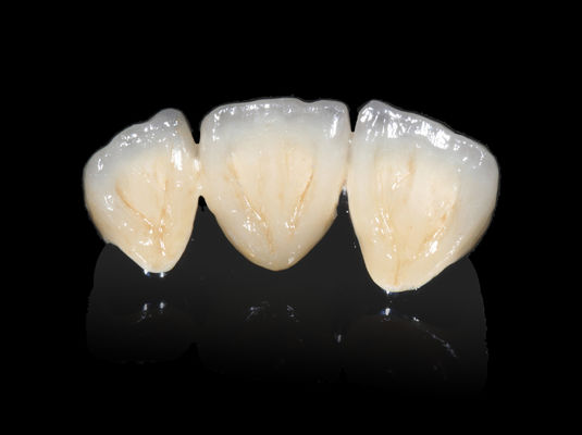 comprare Implantazione dentale PFM ponte non prezioso CAD CAM PFM corona online manufacture