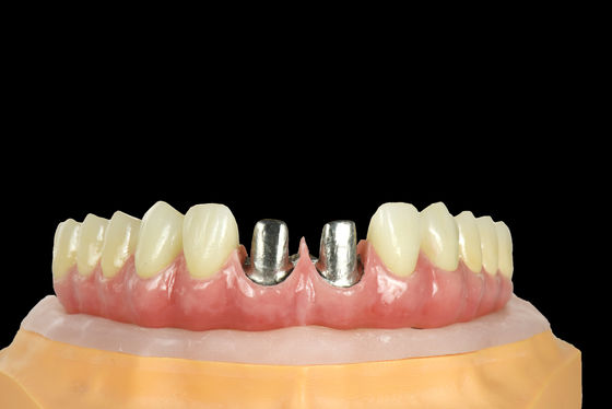 FDA Ponte di Titanio Impianto dentale Cornice di Titanio Con Corona