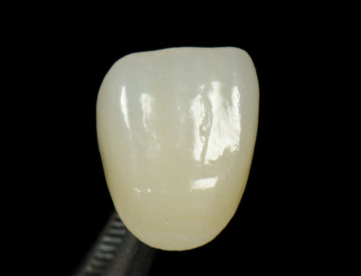 Corone di stampa Emax personalizzabile veloce e elevata estetica inchiostro dentale Onlay