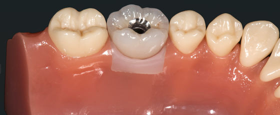 Metalli preziosi altamente estetici Corona impianto Corona ponte Leghe metalliche