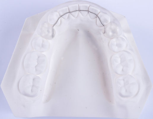 Ritenitori non rimovibili per la lingua Ortodonzia Ritenitori per raddrizzare i denti