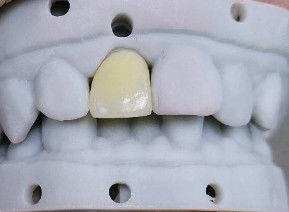 Alta estetica corona composita Onlay Veneer Dimensioni personalizzabili