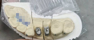 Corone a base di ti metallico / naturale corone a base di titanio per denti