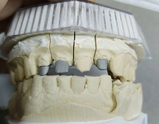 Corone e ponte di metallo non prezioso