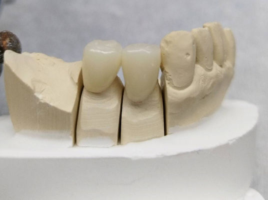 Corone temporanea dentale personalizzata PMMA Corone temporanea ponte e corone