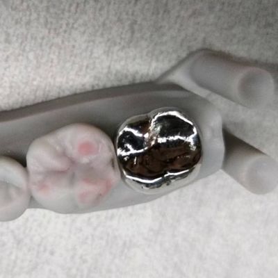Corona di metallo e ponte di alta precisione corona temporanea d'argento