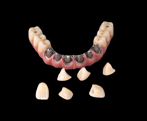 Tutto su X Impianto Titanio Ponte Dental solo quadro professionale