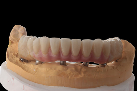 Personalizza gli impianti dentali ibridi Protesi ibrida con barra di titanio