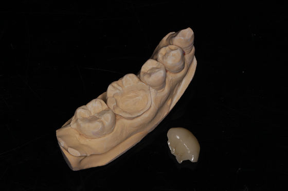 Dental Composite Onlay Veneer Alta estetica Veneer composito